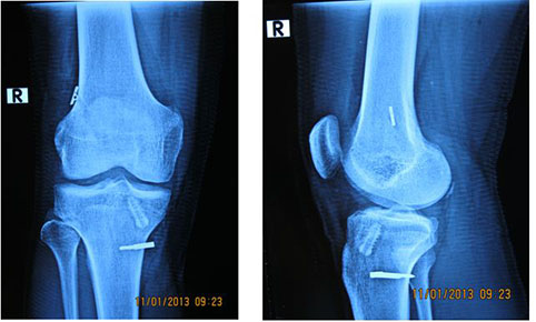 Repair of anterior cruciate ligament