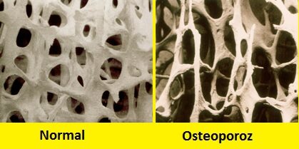 Gençlerde Görülen Osteoporoz ( Premenapozal Osteoporoz )
