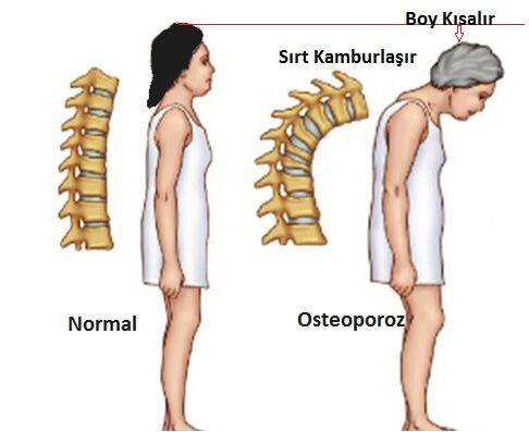 Postmenapozal Osteoporoz (Menapozdan Sonra Görülen Osteoporoz)